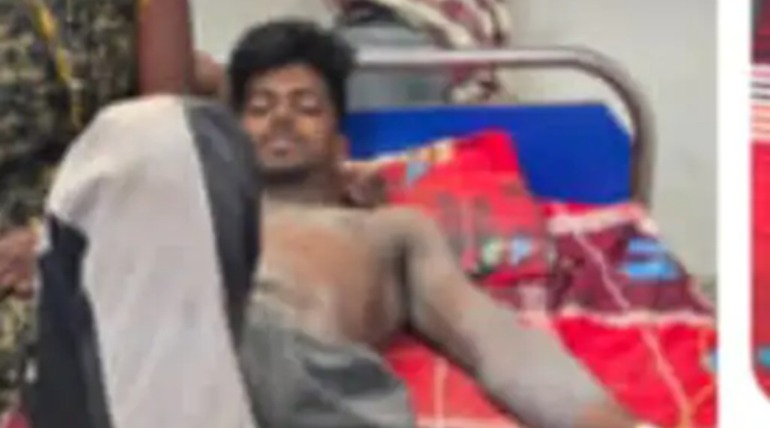 हाईटेंशन तार की चपेट में आया युवक, हाथ, पैर और पेट का हिस्सा झुलसा, इलाज जारी