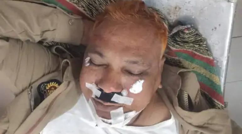 ड्यूटी पर तैनात हेड कॉन्स्टेबल को बोलेरो ने कुचला, जवान का पैर टूटा, चेहरे पर लगी गंभीर चोट